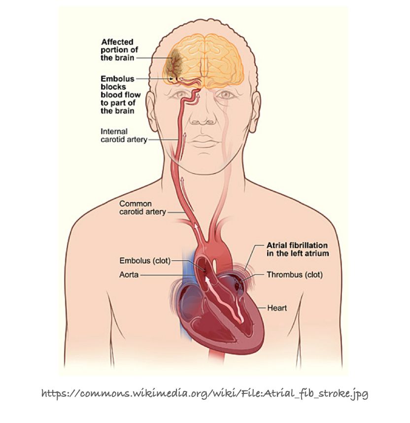 Atrial Fibrillation (AF) - An Important Controllable Condition That Most Have Not Heard Of