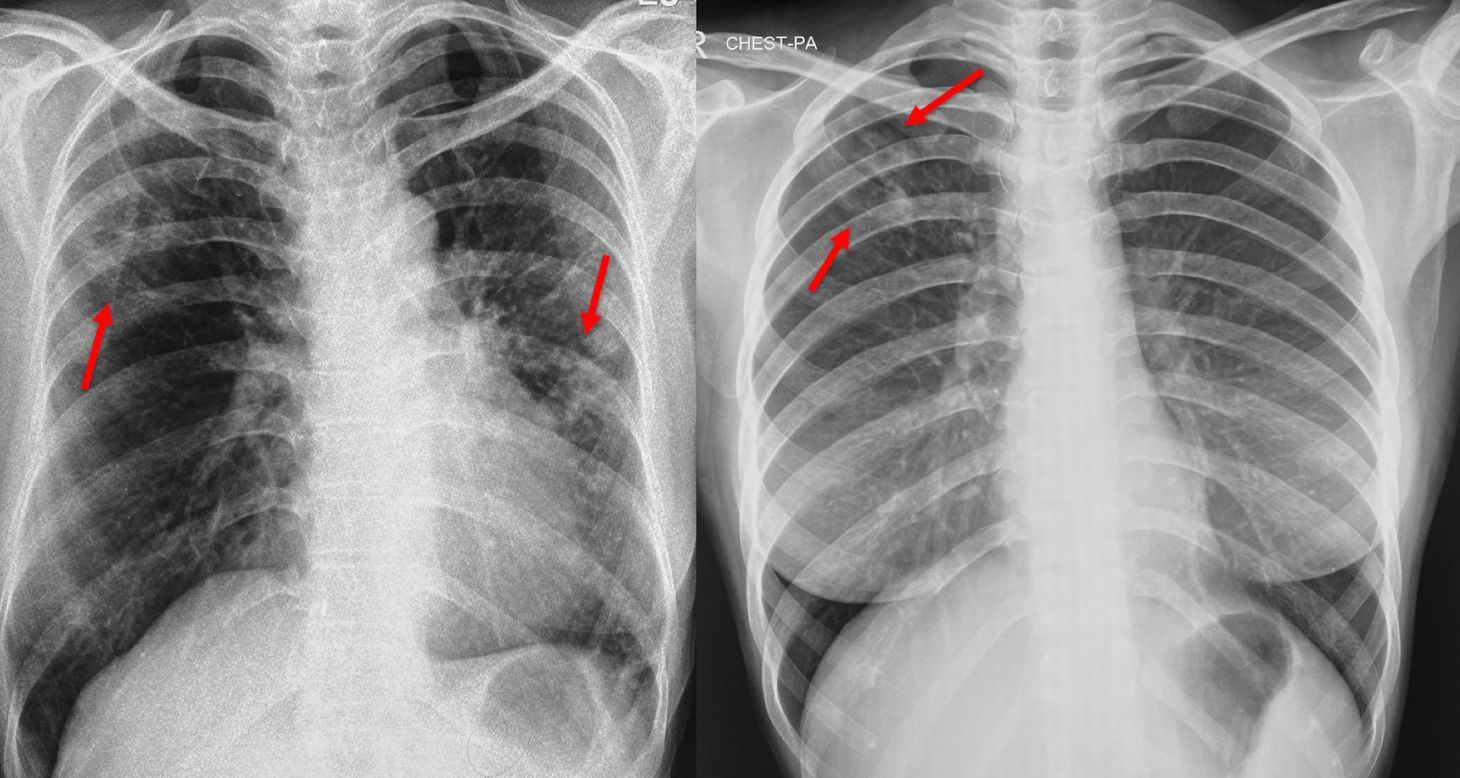 Chest X-ray for Screening for Tuberculosis